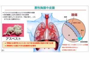 【中古】アスベストと中皮腫 研究成果】国内初！アスベストによるがん｢悪性胸膜中皮腫｣の根治目指す
