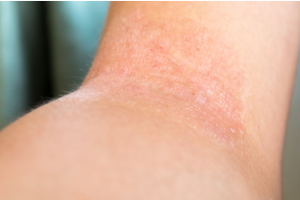 ティーズ（TIS）｜アトピー性皮膚炎に経口の新たな治療選択肢